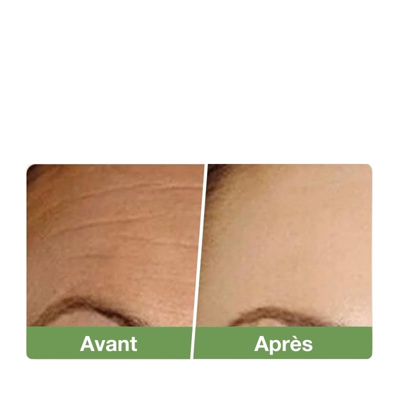 Épurateur de peau à ultrasons