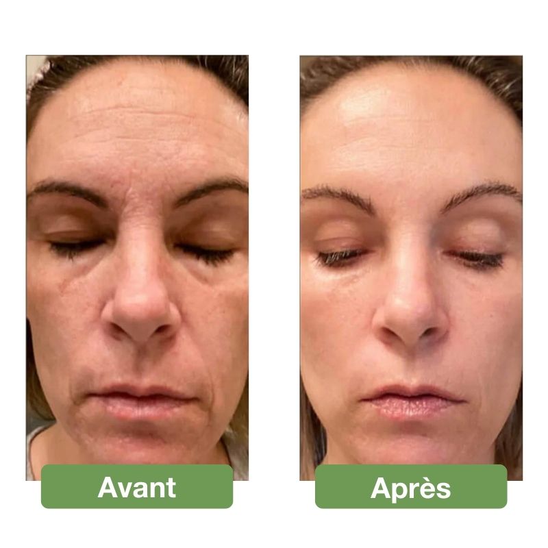 Appareil d'électrothérapie à haute fréquence pour le visage