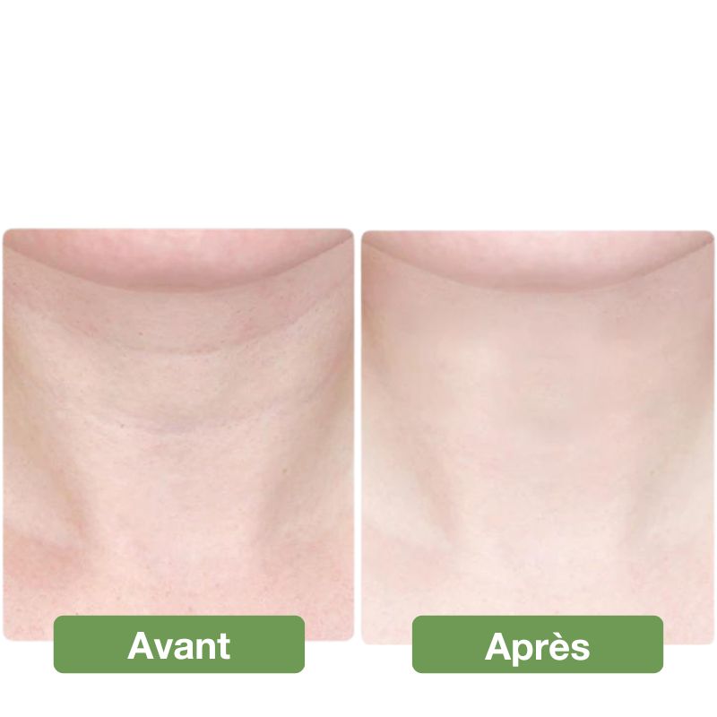 Appareil anti double menton