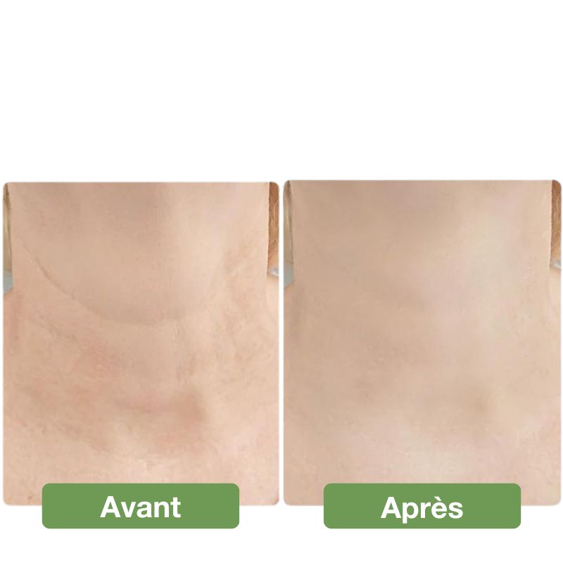 Appareil anti double menton