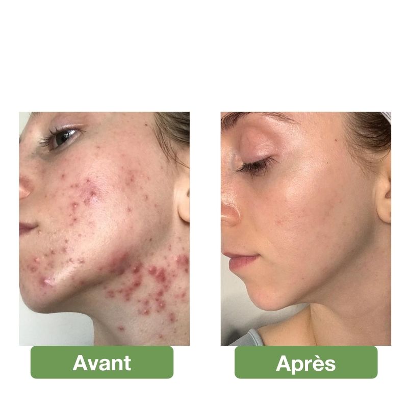 Appareil d'électrothérapie à haute fréquence pour le visage