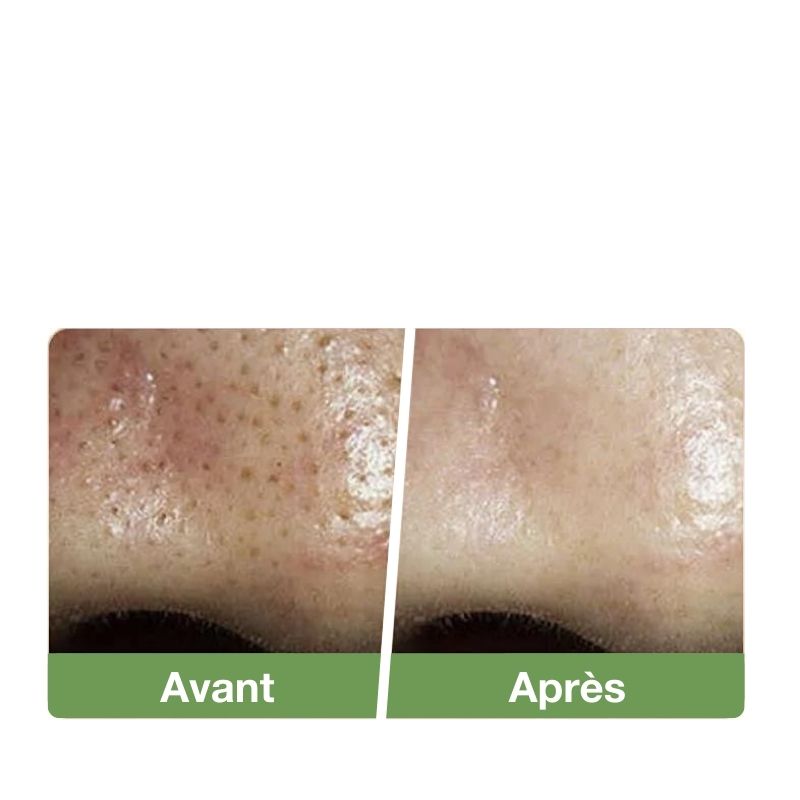 Épurateur de peau à ultrasons