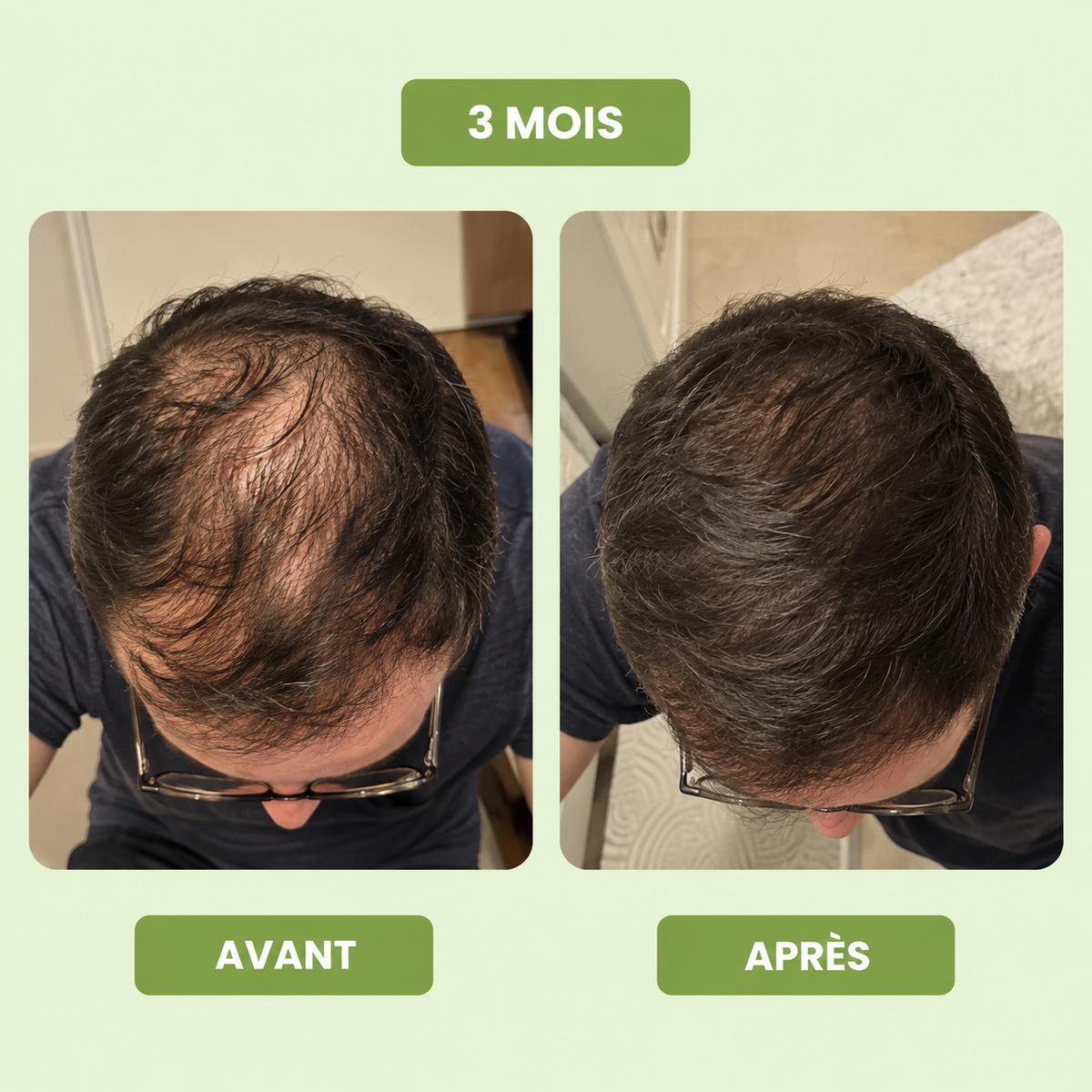 Vitalis® Sérum de Croissance Capillaire pour Hommes