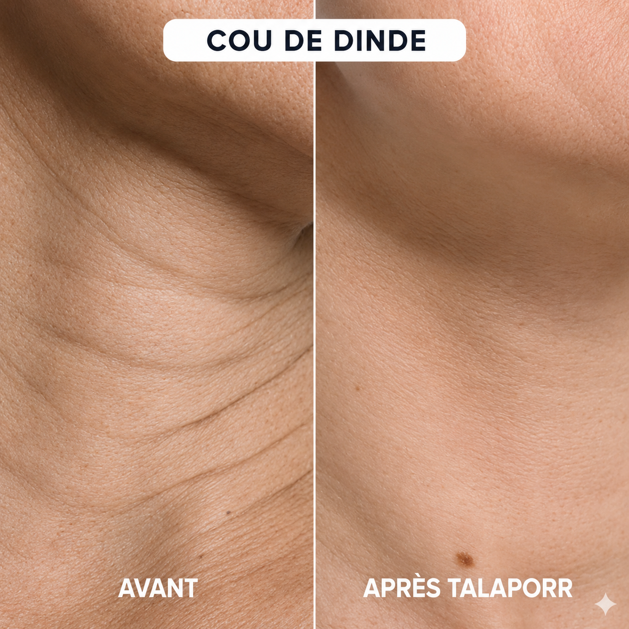 Le système de micro-infusion™