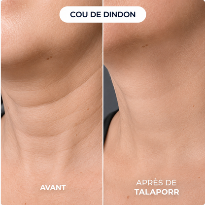 Le système de micro-infusion™