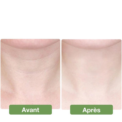 Appareil anti double menton