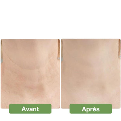 Appareil anti double menton